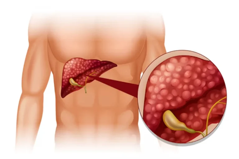 Understanding Gallstones A Comprehensive Overview